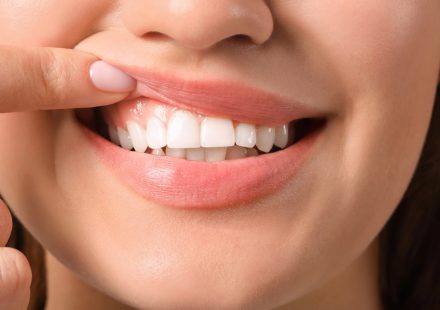 Gum Treatment in Australia